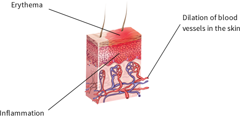 WHAT IS SENSITIVE SKIN WITH REDNESS?